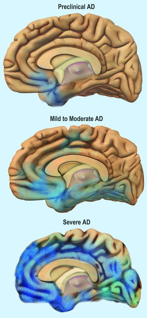 Unlocking New Pathways to Detect Brain Diseases