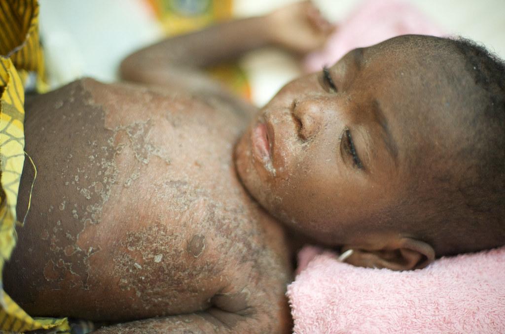 - Steps to Take in Preventing the Spread of Measles and Protecting Public Health